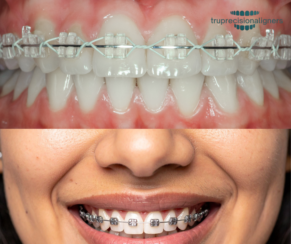 Ceramic Braces vs Metal Braces:Now Make a Clear Decision Between Metal and Ceramic Braces!
